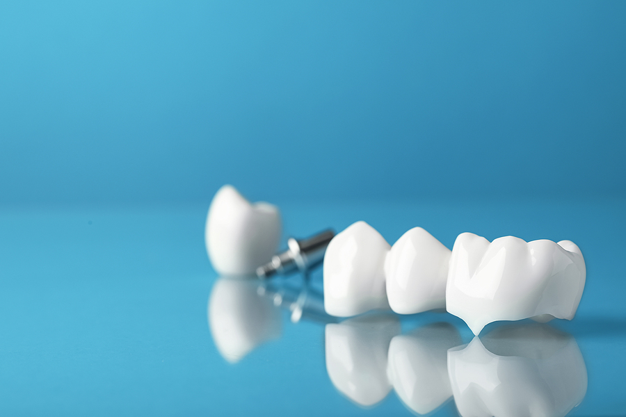 Dental Crowns: A Modern Solution for Age-Old Dental Problems