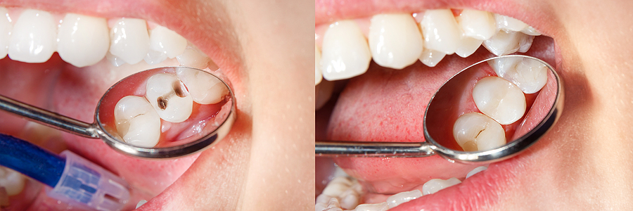 Everything You Need to Know About Dental Composites in Nashville, TN