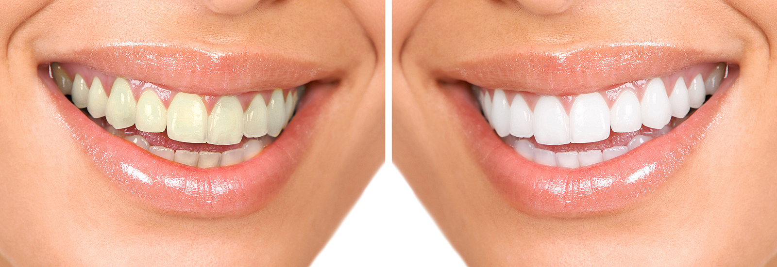 Achieve a Brighter Smile with Zoom Whitening in Nashville, TN